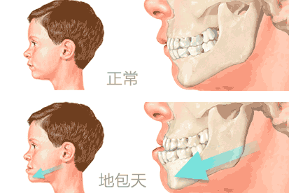 儿童地包天什么时候治疗更好